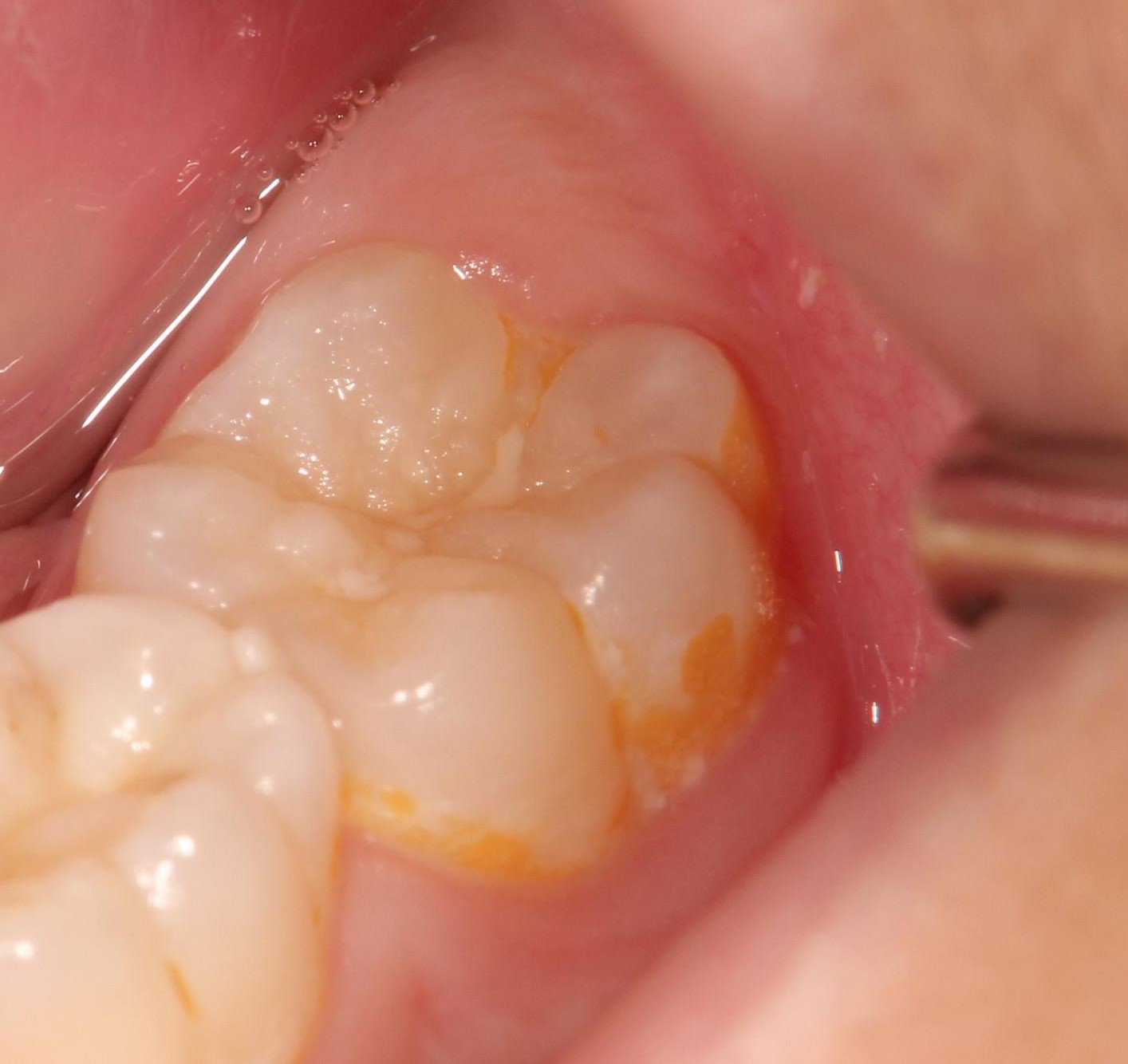 子供の歯の表面がオレンジ色に 久我山駅前歯科 矯正歯科