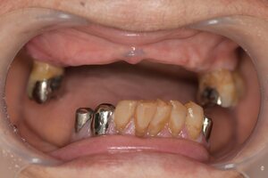 入れ歯の症例