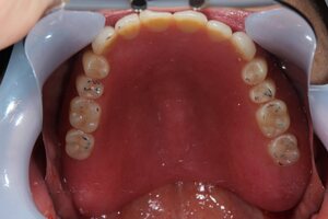 マグネットアタッチメント入れ歯の症例